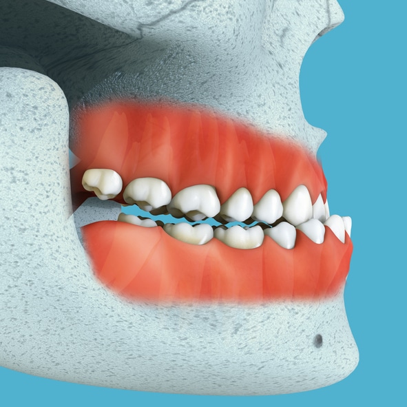 Orthognathic surgery and orthodontic treatment at Advanced Orthodontics in Everett, WA 98208 improving function and facial balance