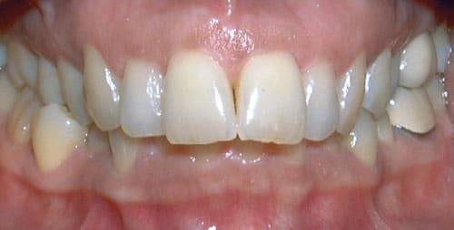 Overbite condition at Advanced Orthodontics in Everett, WA where upper teeth overlap lower teeth