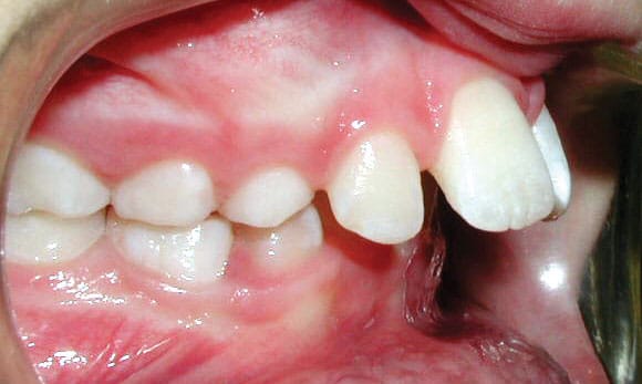 Protruding front teeth at Advanced Orthodontics in Everett, WA showing overjet condition