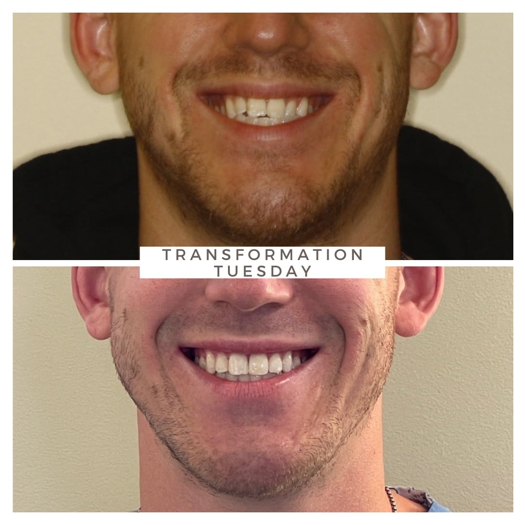 Before and after comparison of a young man's smile transformation showing improved teeth alignment in Case 2 at Advanced Orthodontics in Everett, WA